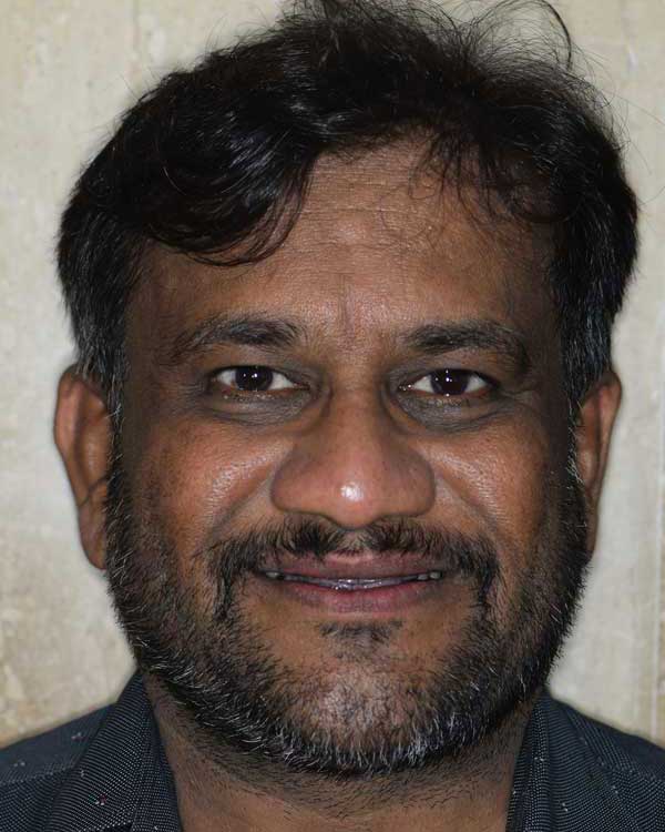 Smile transformation